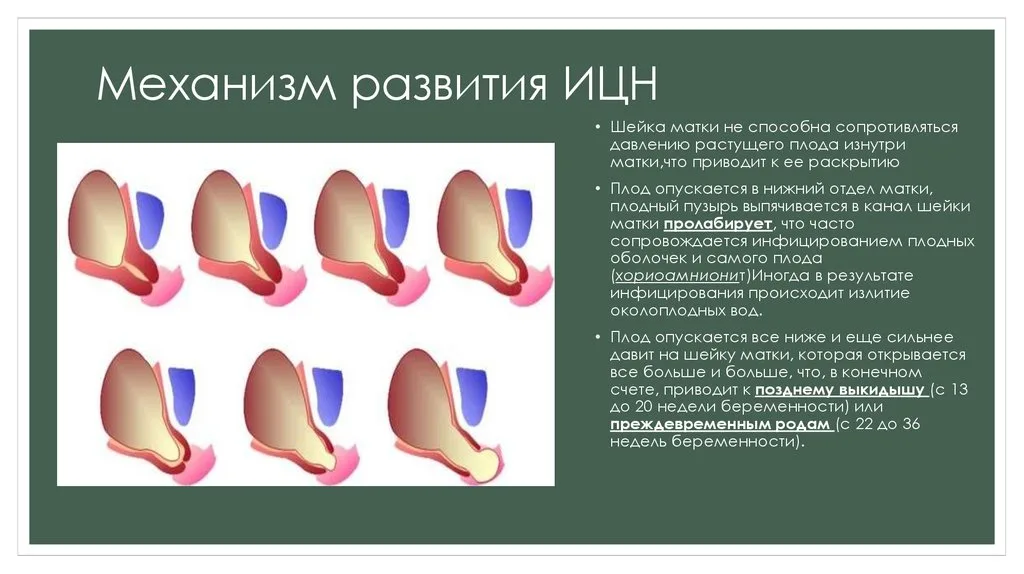 Истмико-цервикальная недостаточность