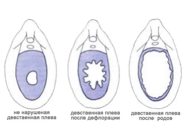 Что такое девственная плева