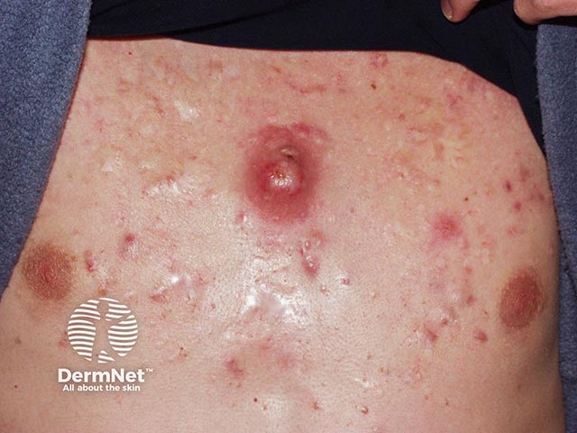 Акне на груди с папулами, пустулами, шрамами и большой кистой от акне