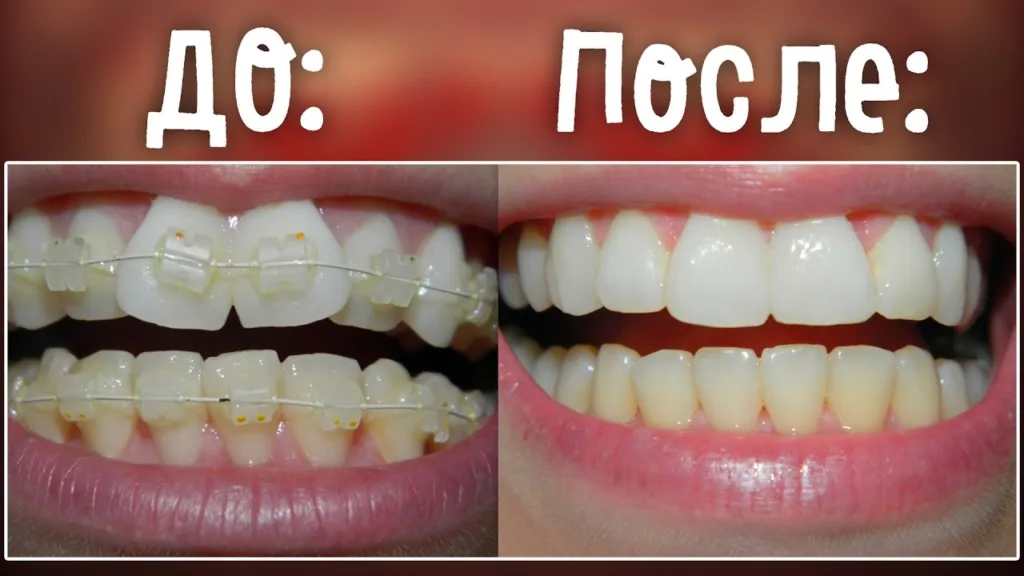 Первый опыт ношения брекетов: ощущения, уход и эмоции