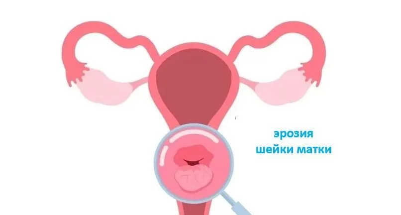 Эктопия (эрозия) шейки матки