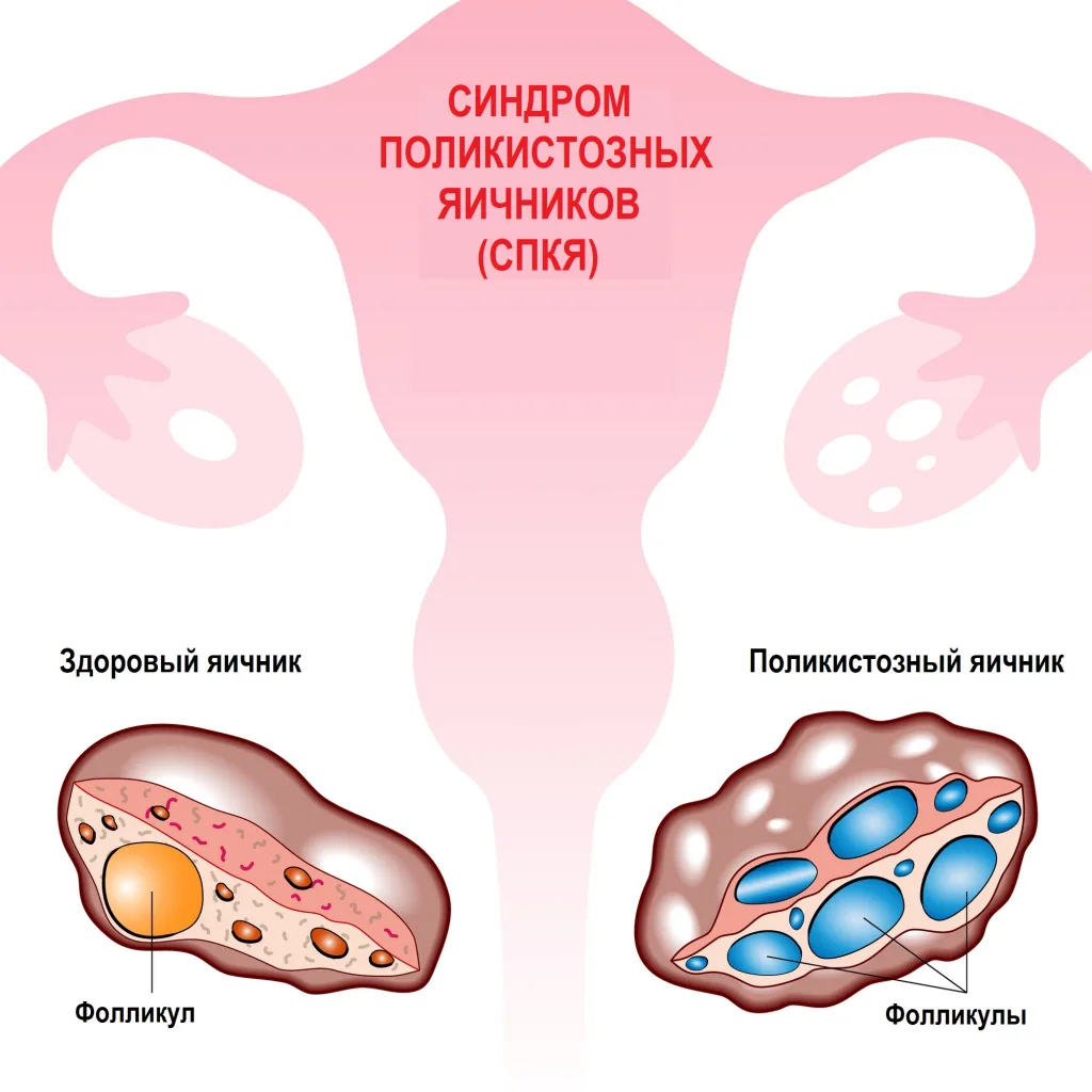 Можно ли забеременеть при СПКЯ (синдроме поликистозных яичников)