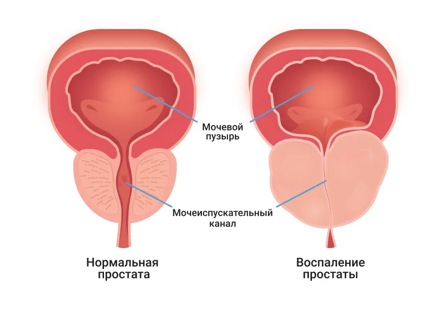 Простатит: правда и мифы о «втором сердце» мужчины
