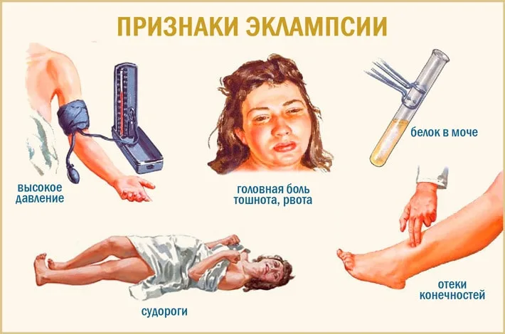 Эклампсия