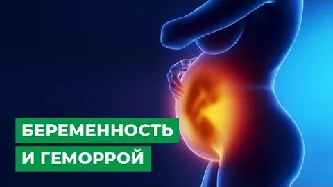 Геморрой во время беременности