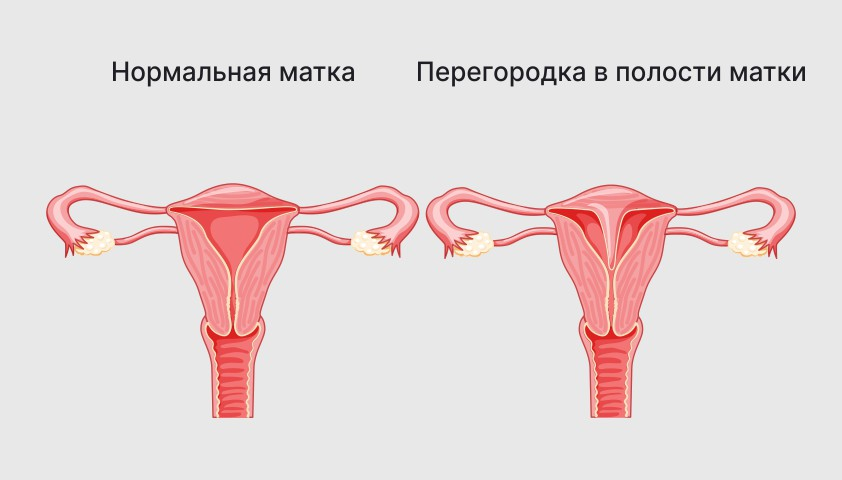 Нормальная матка vs. перегородка в полости матки