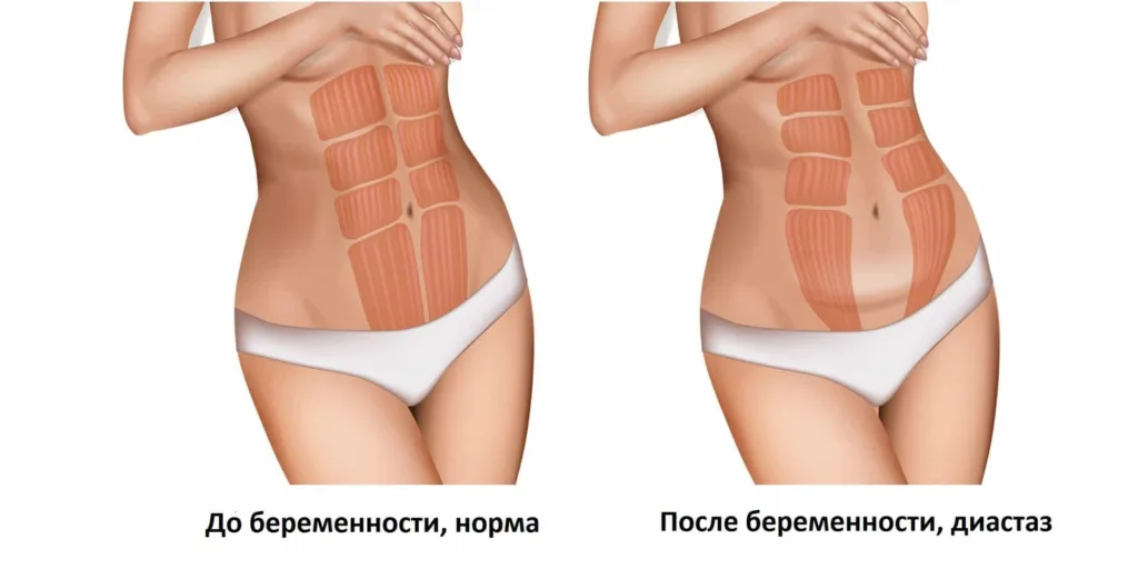 Диастаз прямых мышц живота: как проверить и какие упражнения нельзя