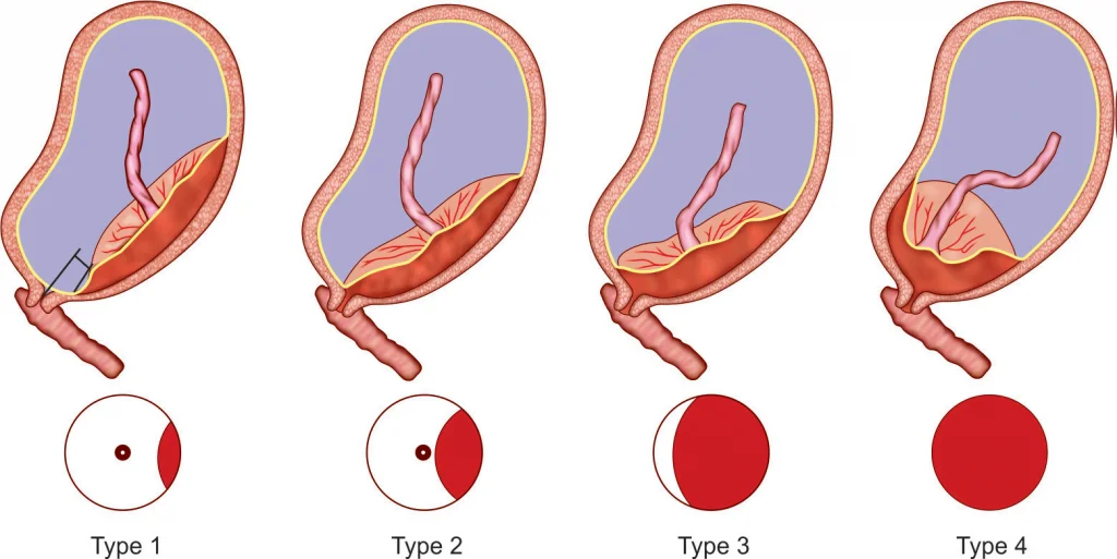 Предлежание плаценты (Placenta previa)