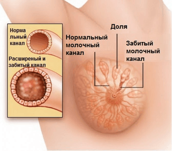 Проходимость млечного протока