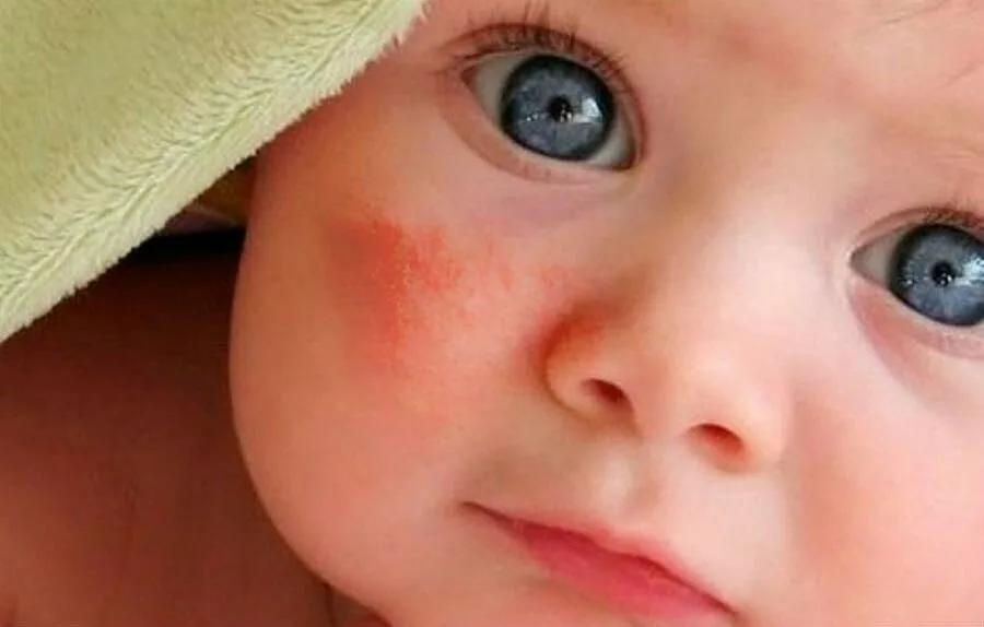 Аллергия у малышей 1–3 лет: крапивница, отёк, анафилаксия — алгоритм действий