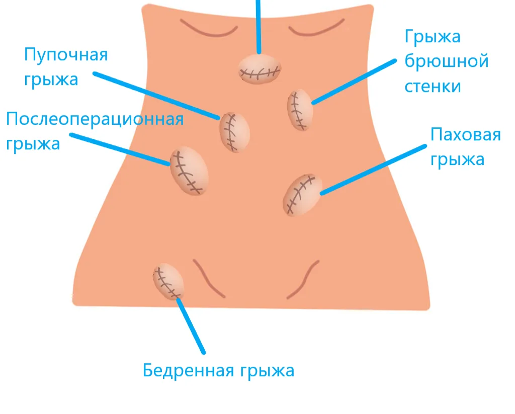 Грыжи и слабость брюшной стенки после беременности: как распознать, что делать и когда к врачу