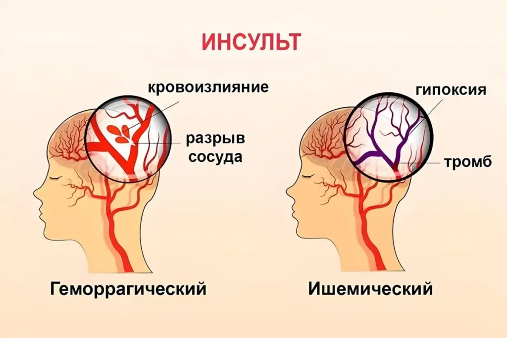 Геморрагический vs ишемический инсульт: в чём разница