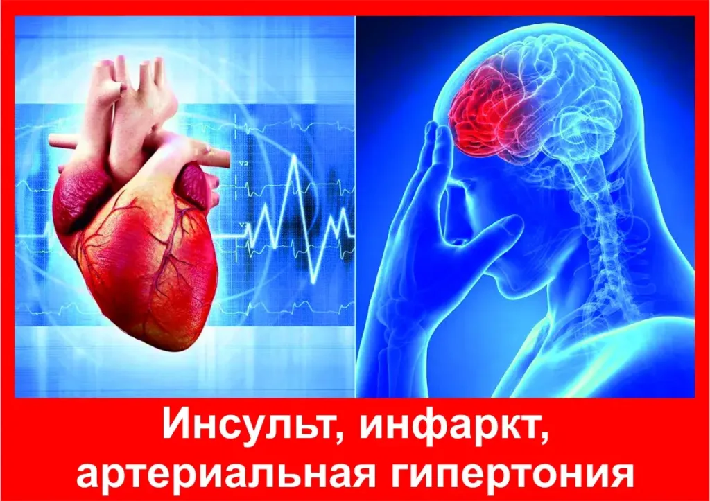 Как давление связано с риском инсульта