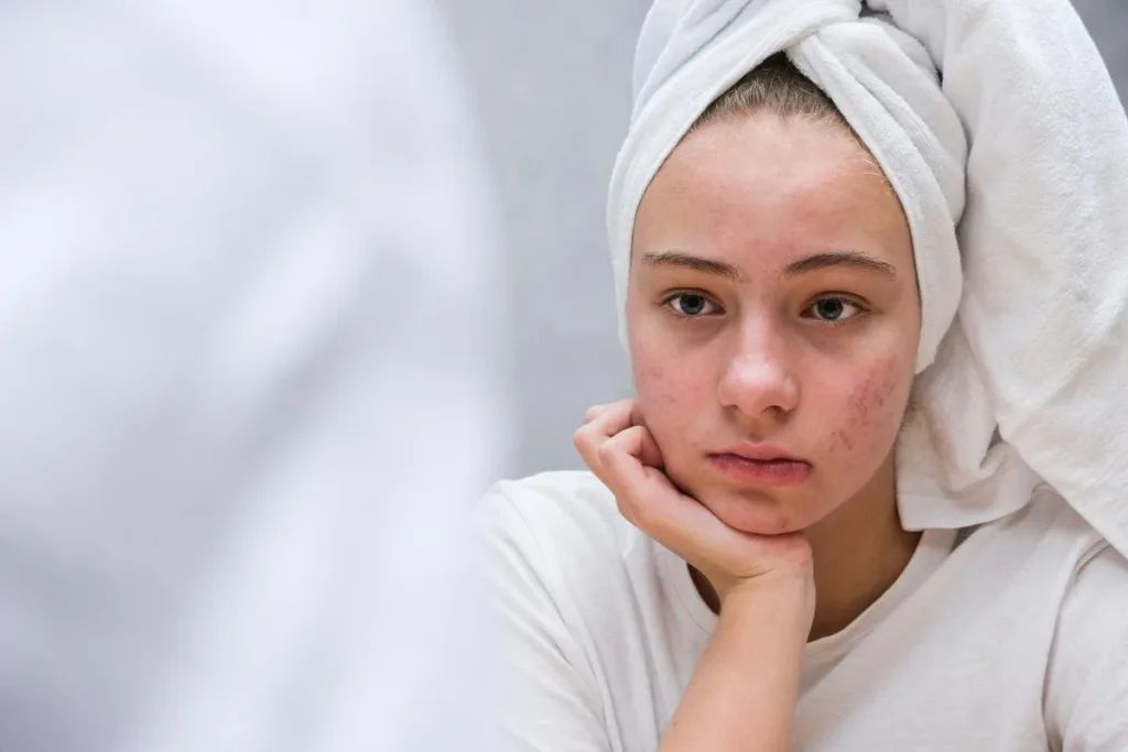 Прыщи и самооценка у подростка 12–18 лет: как поддержать