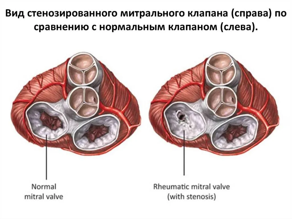 Ревматизм и пороки сердца: как ангина разрушает клапаны