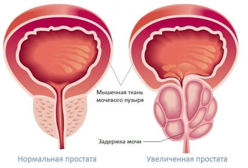 Доброкачественная гиперплазия простаты (ДГПЖ): почему железа увеличивается с возрастом