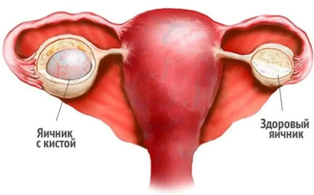 Кисты яичников: функциональные и патологические — в чём разница