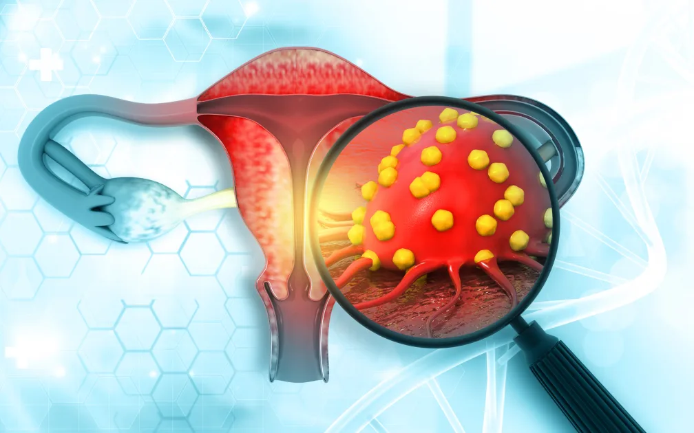 Наследственный рак яичников: мутации BRCA1 и BRCA2