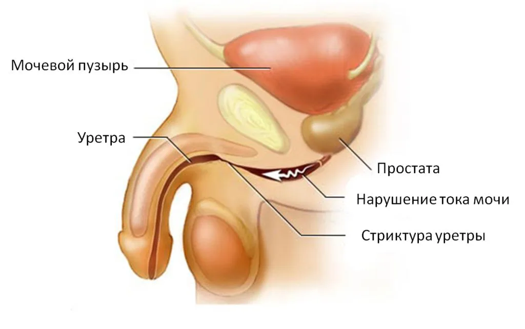 Стеноз уретры и дивертикул мочевого пузыря: приобретённые изменения мочевыводящих путей