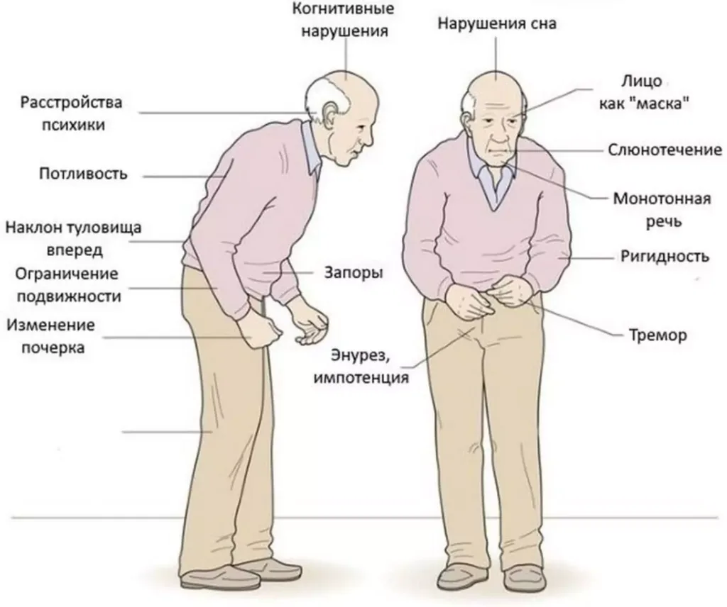 Болезнь Паркинсона: что происходит в мозге, первые симптомы и чем тремор отличается от других видов дрожи