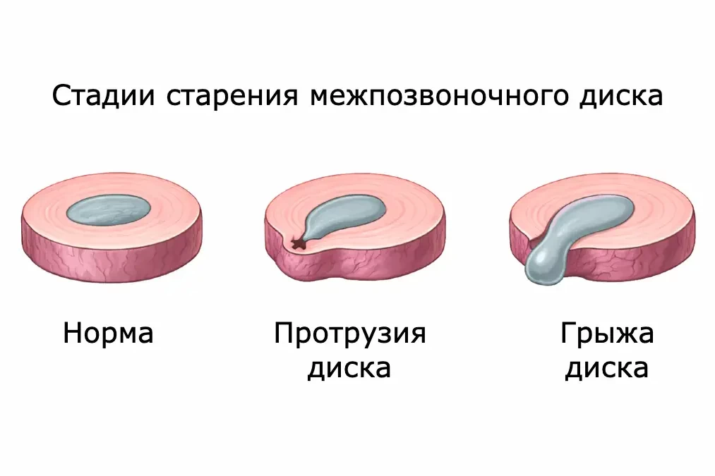 Протрузия диска vs грыжа диска: в чём разница и что опаснее