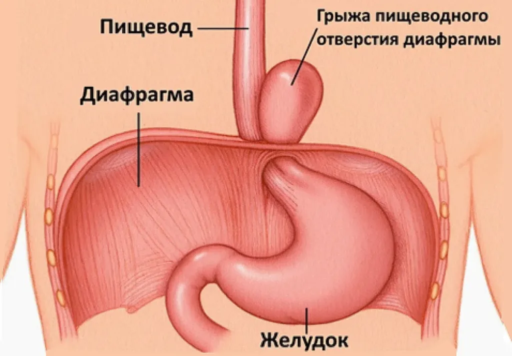 Грыжа пищеводного отверстия диафрагмы: как она усиливает рефлюкс