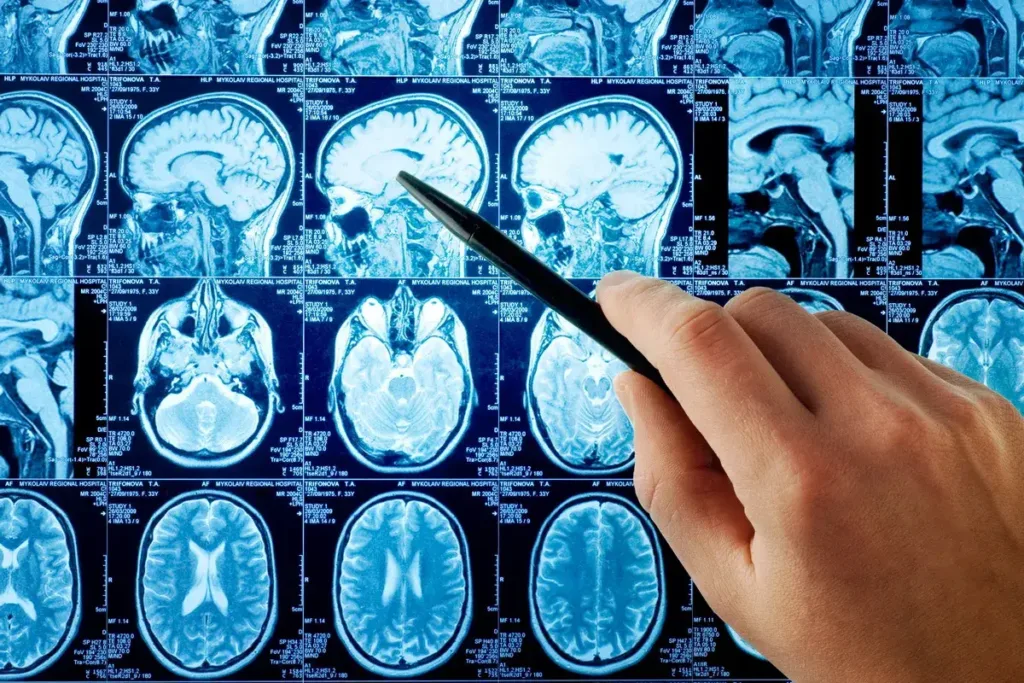 Метастазы в мозг: как часто бывают и как лечат
