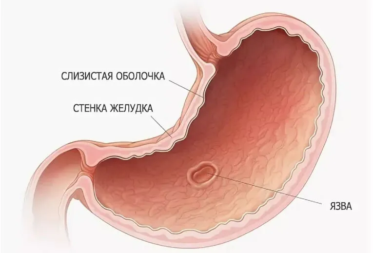 Язва желудка: почему возникает и всегда ли нужна операция